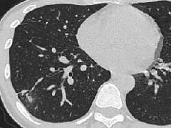 迅速增大的肺部结节，首先考虑良性，确诊需要肺穿