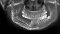 颌骨促结缔组织增生性纤维瘤1例
