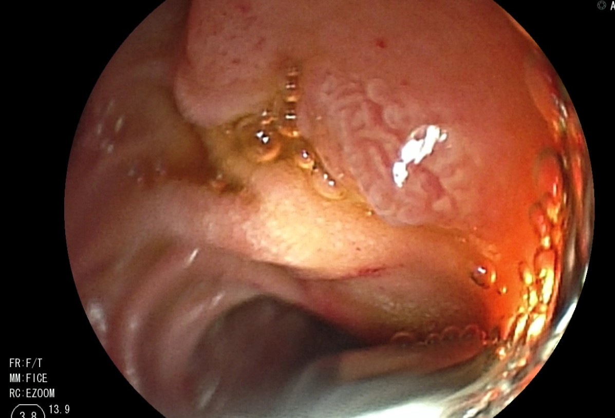 图1-An Unusual Cause of Acute Pancreatitis.png