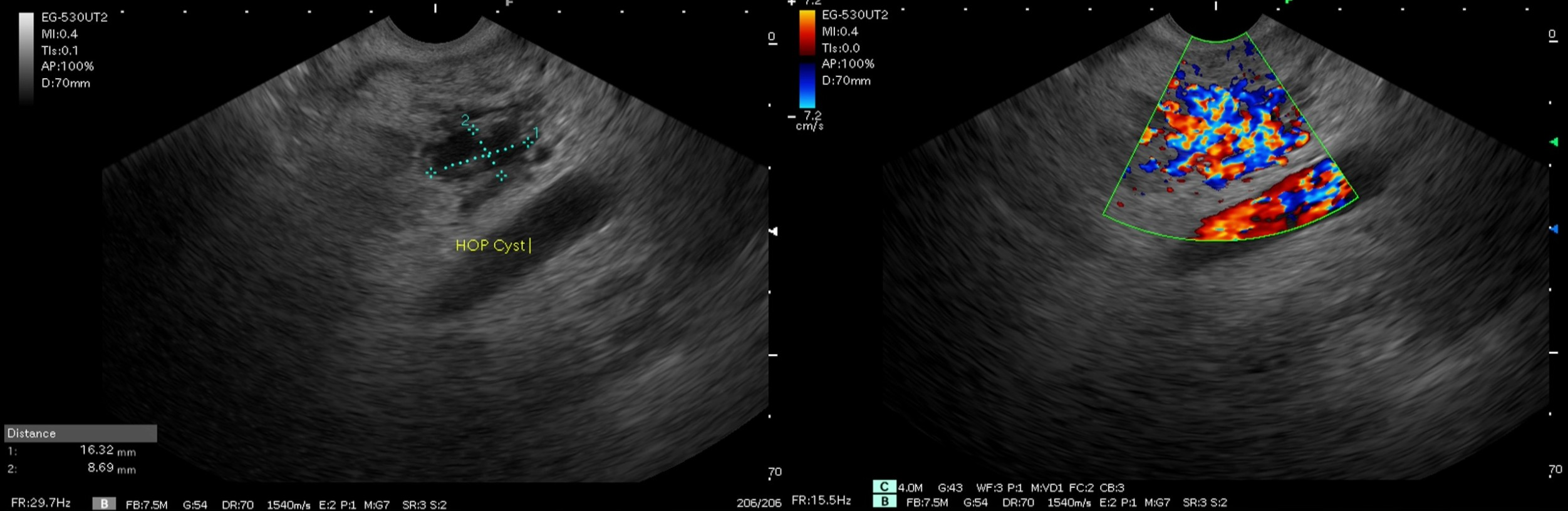 图2-An Unusual Cause of Acute Pancreatitis.png