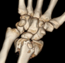 桡骨远端骨折术后拇长屈肌腱断裂2例