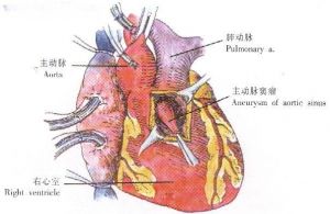 主动脉窦动脉瘤