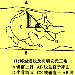 髂坐连线（ Nelaton线）