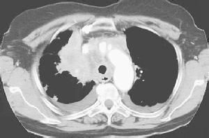 上腔静脉综合征