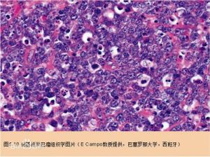 伯基特淋巴瘤