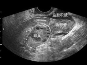 盆腔积液