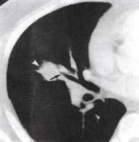 “阳性支气管征” 的影像表现与临床意义