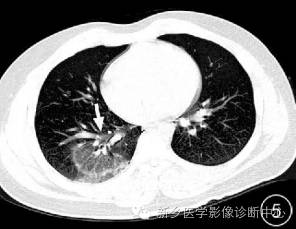 肺撕裂伤原来有四种分型，您知道吗？