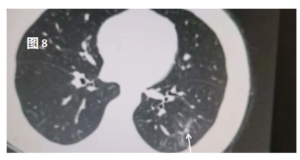 新型冠状病毒肺炎在肺部CT上是这样的