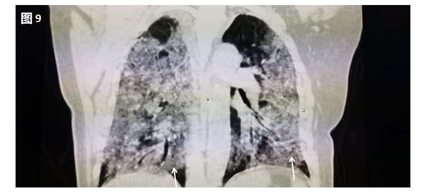 新型冠状病毒肺炎在肺部CT上是这样的