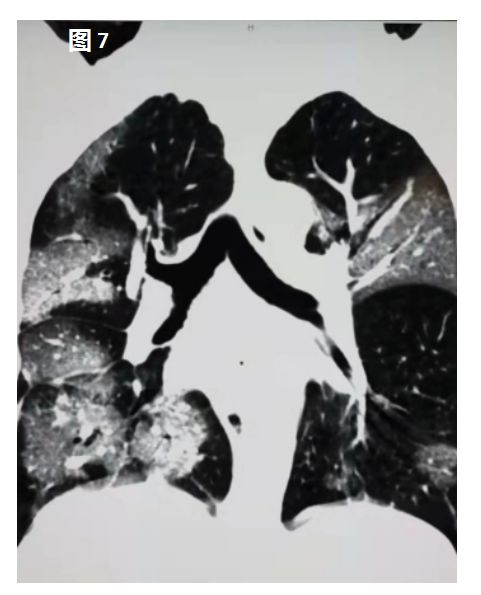新型冠状病毒肺炎在肺部CT上是这样的