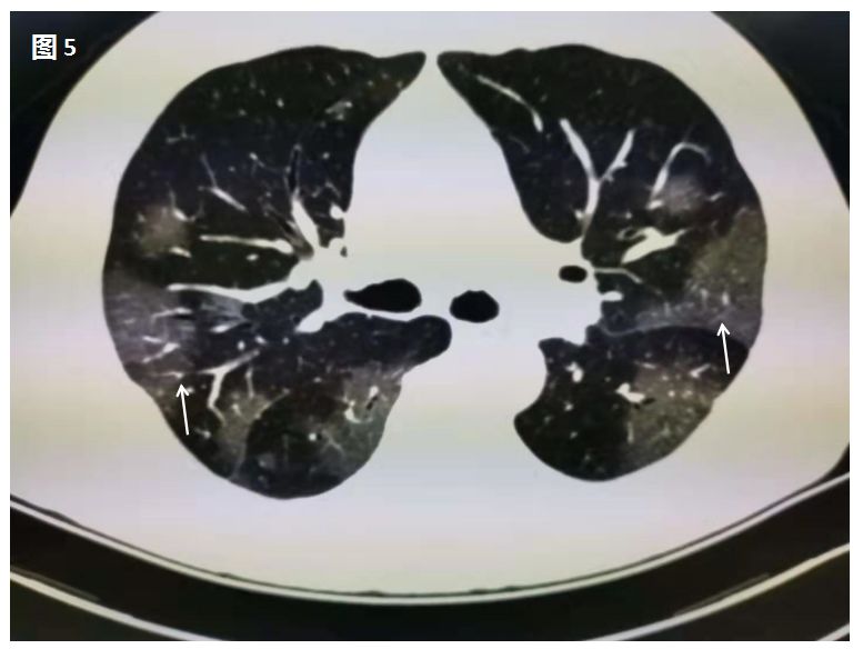 新型冠状病毒肺炎在肺部CT上是这样的