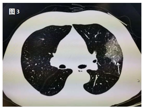 新型冠状病毒肺炎在肺部CT上是这样的