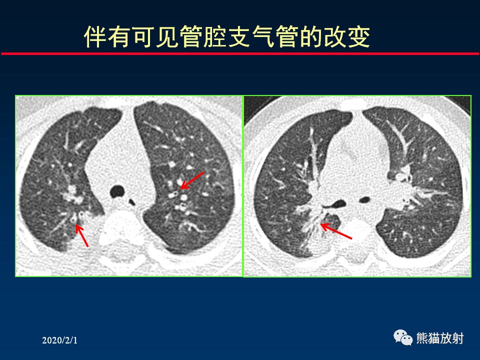 【PPT】精准判读支气管感染的基本CT表现