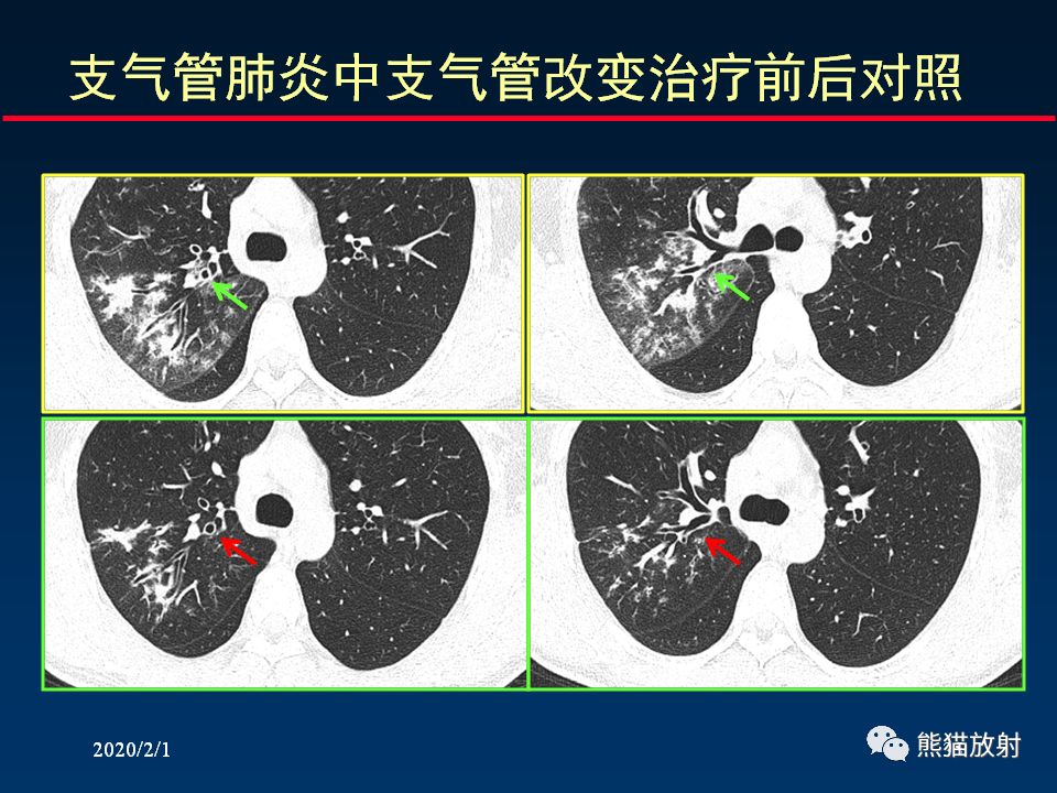 【PPT】精准判读支气管感染的基本CT表现