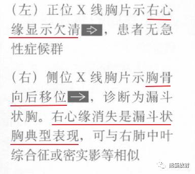 【书摘】“右肺中叶综合征”的鉴别诊断