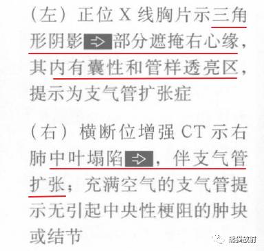 【书摘】“右肺中叶综合征”的鉴别诊断