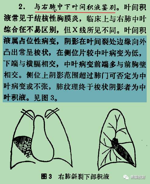 【书摘】“右肺中叶综合征”的鉴别诊断