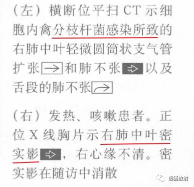 【书摘】“右肺中叶综合征”的鉴别诊断