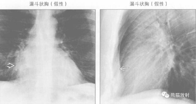 【书摘】“右肺中叶综合征”的鉴别诊断