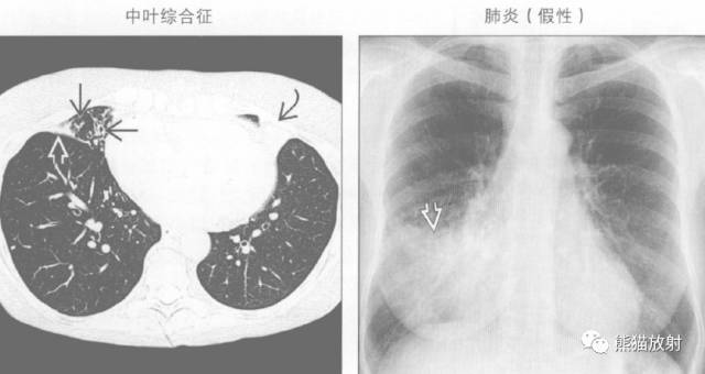 【书摘】“右肺中叶综合征”的鉴别诊断