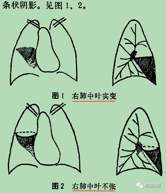 【书摘】“右肺中叶综合征”的鉴别诊断