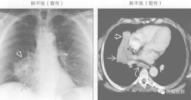 【书摘】“右肺中叶综合征”的鉴别诊断