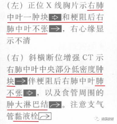 【书摘】“右肺中叶综合征”的鉴别诊断