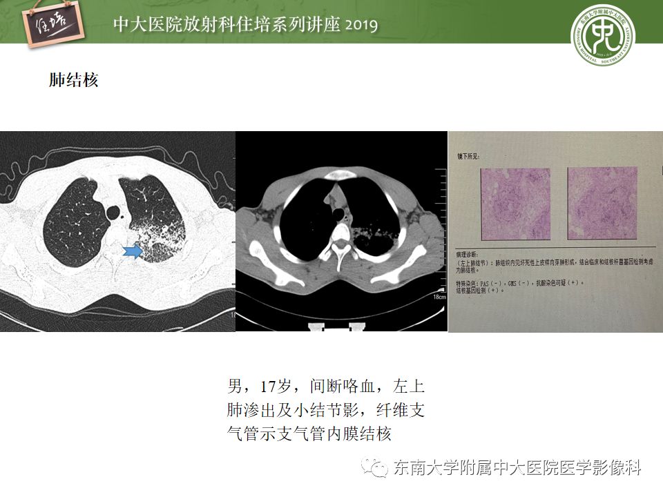 【PPT】咯血的临床及影像分析思路