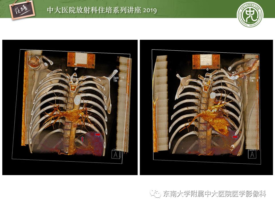 【PPT】咯血的临床及影像分析思路