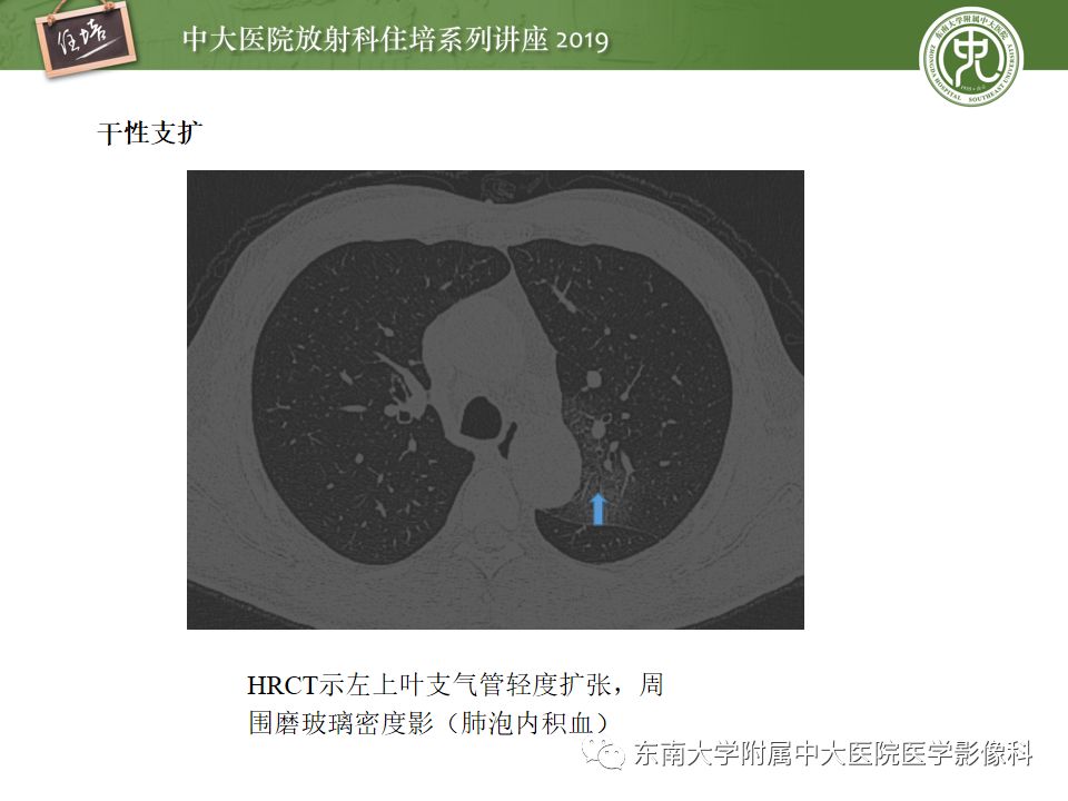 【PPT】咯血的临床及影像分析思路