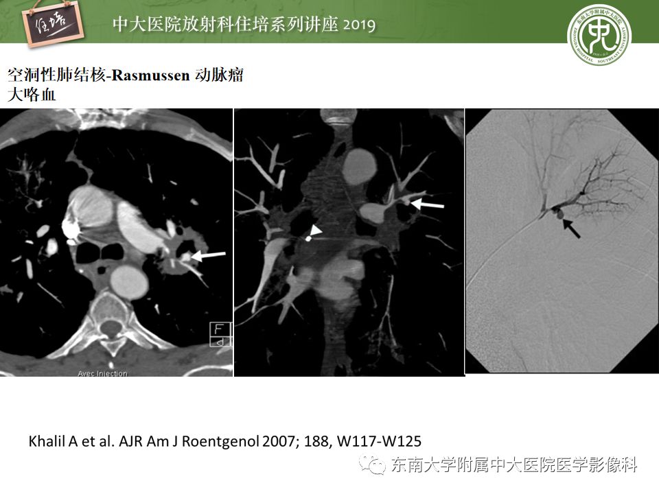 【PPT】咯血的临床及影像分析思路