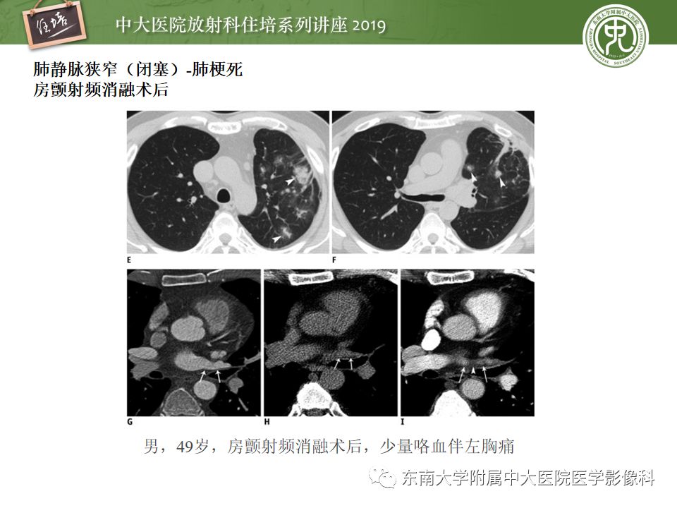 【PPT】咯血的临床及影像分析思路
