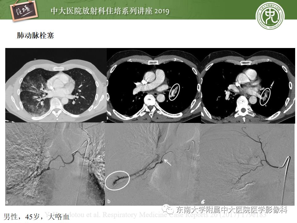 【PPT】咯血的临床及影像分析思路