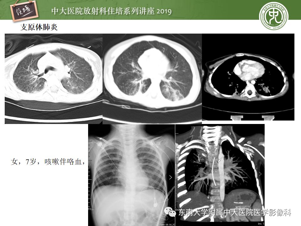 【PPT】咯血的临床及影像分析思路