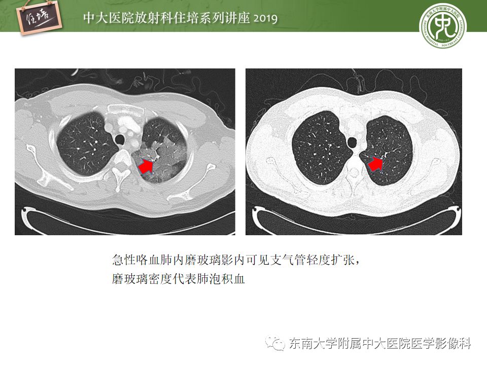 【PPT】咯血的临床及影像分析思路