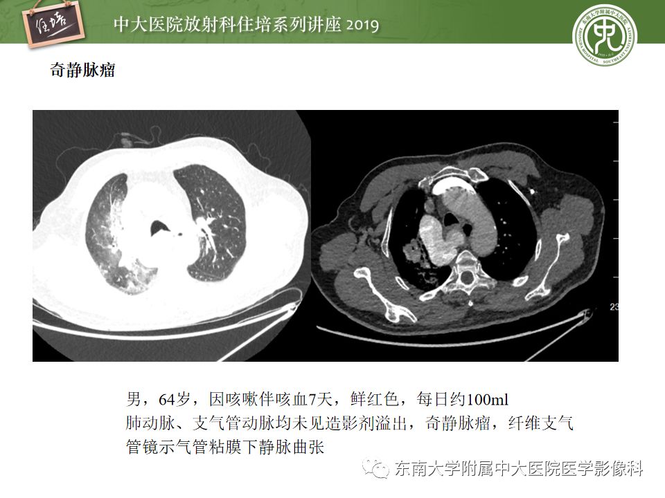 【PPT】咯血的临床及影像分析思路
