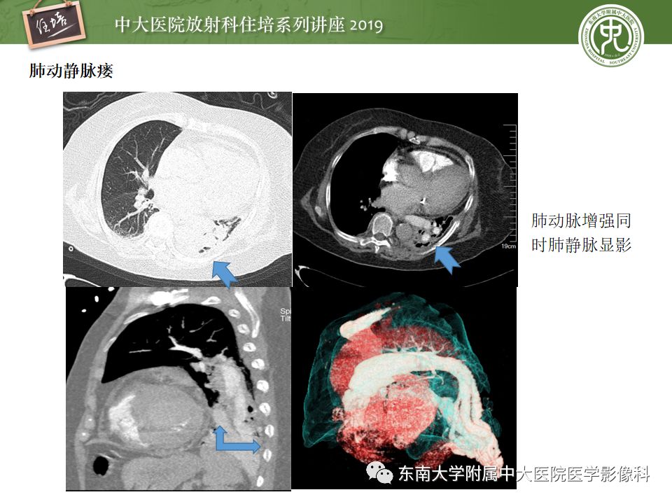 【PPT】咯血的临床及影像分析思路