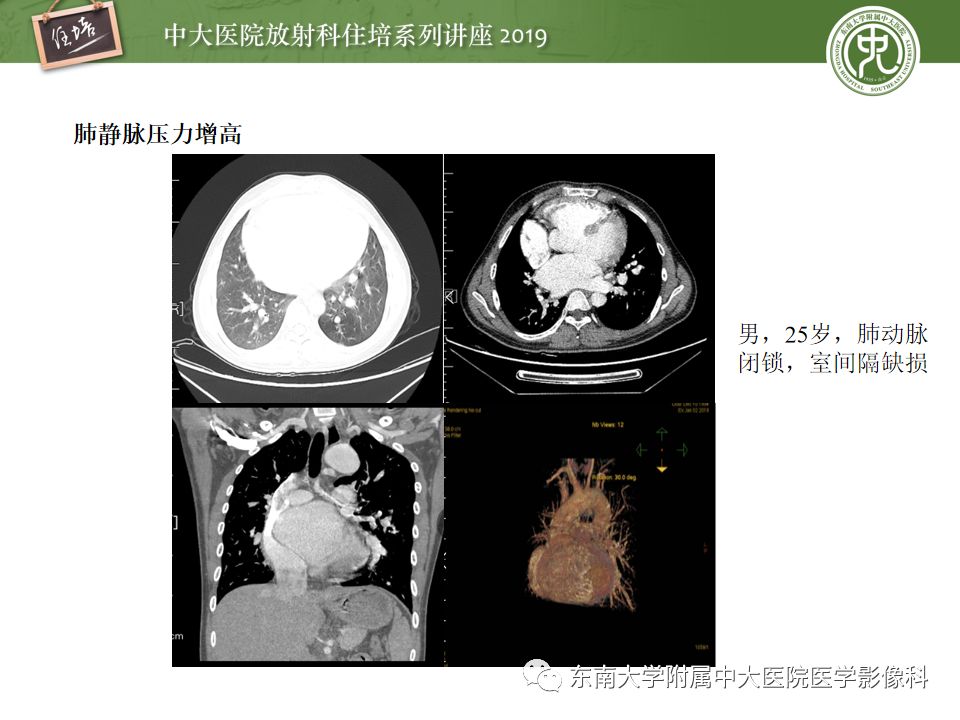 【PPT】咯血的临床及影像分析思路