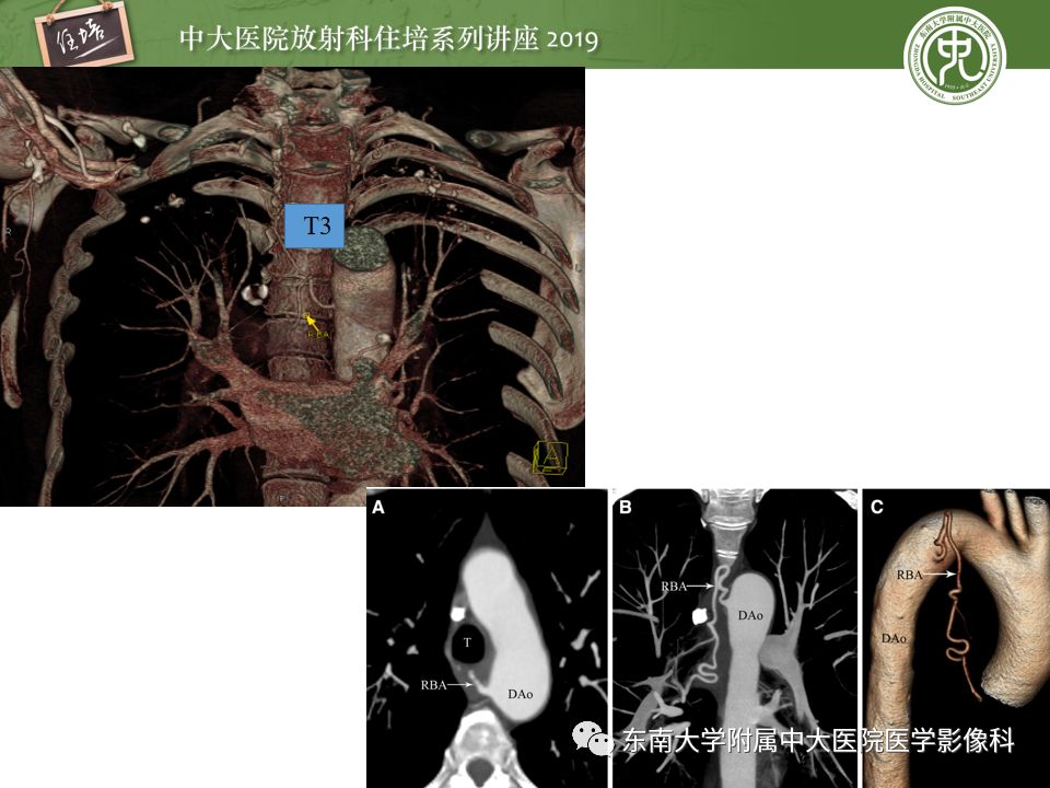 【PPT】咯血的临床及影像分析思路