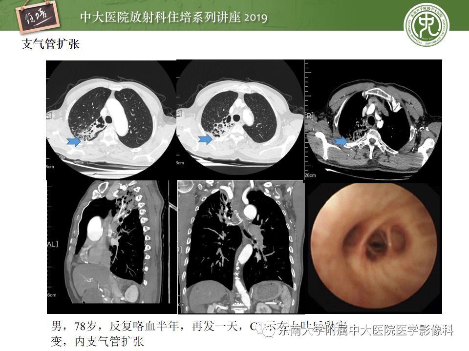 【PPT】咯血的临床及影像分析思路