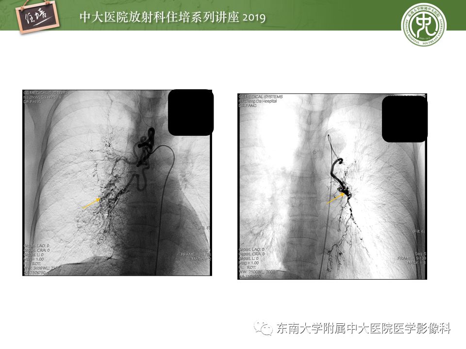【PPT】咯血的临床及影像分析思路