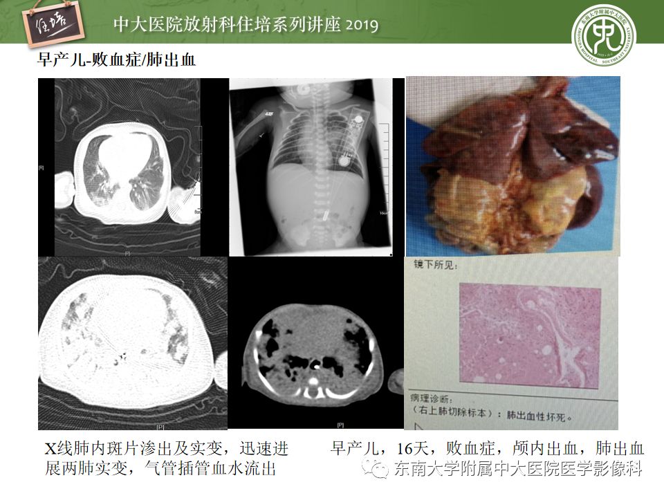 【PPT】咯血的临床及影像分析思路