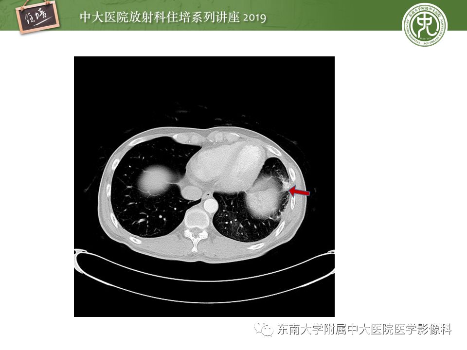 【PPT】咯血的临床及影像分析思路