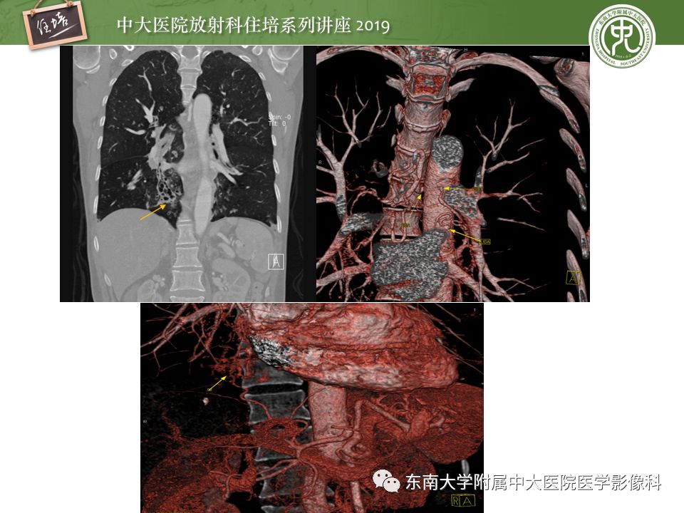 【PPT】咯血的临床及影像分析思路