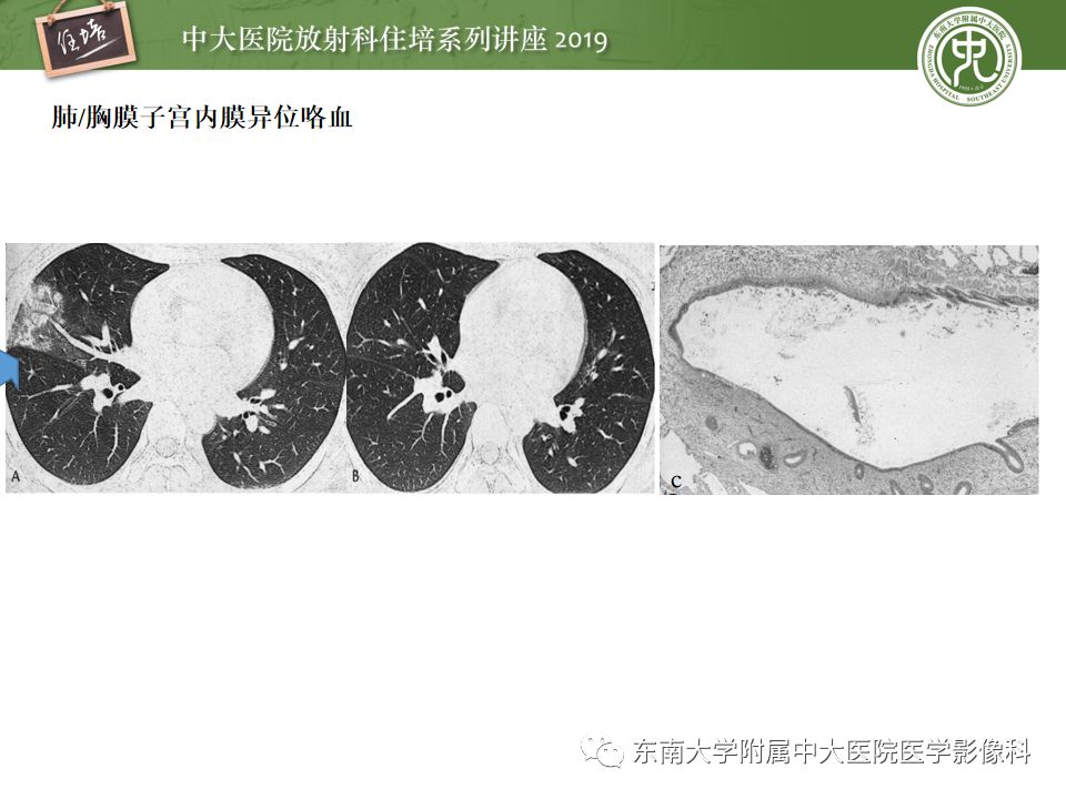【PPT】咯血的临床及影像分析思路