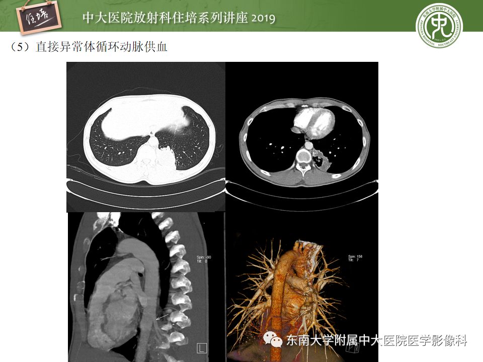 【PPT】咯血的临床及影像分析思路