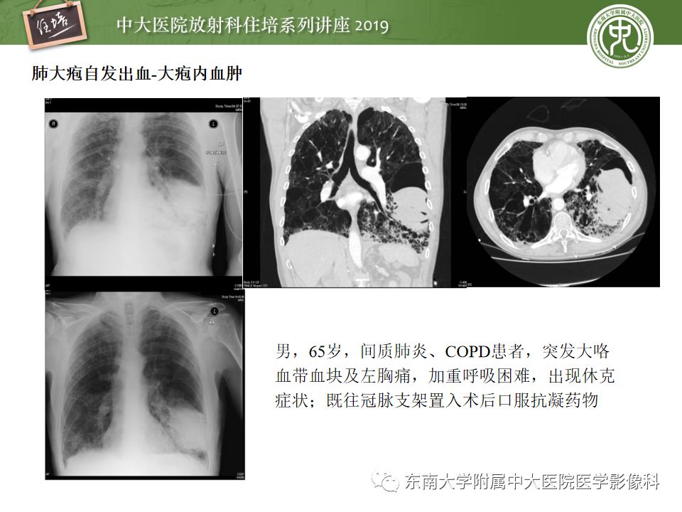 【PPT】咯血的临床及影像分析思路