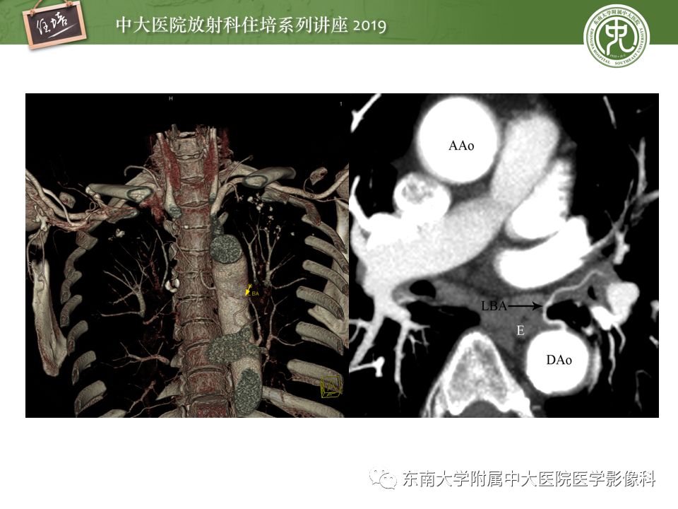 【PPT】咯血的临床及影像分析思路