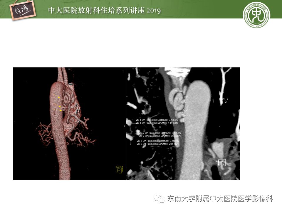 【PPT】咯血的临床及影像分析思路
